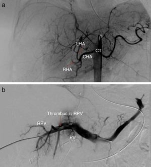 (a) Hepatic arteriography; (b) Transhepatic portography with absence of left portal branch. CHA, common hepatic artery; RHA, right hepatic artery; LHA, left hepatic artery; CT, celiac trunk; PV, portal vein; RPV, right portal vein.