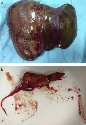 (a) Explanted liver; (b) Portal thrombus.