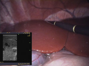 Intraoperative ultrasound performed during a totally laparoscopic liver resection in an ovine model, in a simulated operating room.