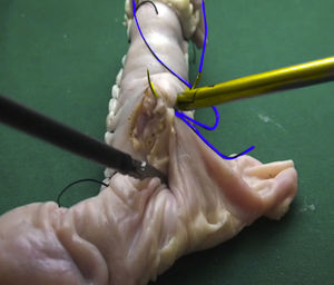 Image taken from the instructional video in a high-definition endotrainer showing how to perform the first sutures for posterior wall closure in a laparoscopic gastrojejunal anastomosis. Suture needle and thread appear highlighted in yellow and blue, respectively.