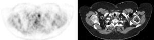 CT scan showing a left thyroid nodule with nonspecific characteristics and PET image showing pathologic uptake.