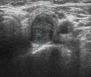 Ultrasound showing a solid, well-defined, hypoechoic nodule that is mildly heterogeneous in the interior, which coincides with the characteristics of metastatic thyroid nodules described in the literature.