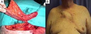 (A) Intraoperative image of the flap design where one can observe the internal mammary artery perforator and the muscular ellipse included in the design. (B) Clinical image taken 2 years after surgery, demonstrating stable coverage and recovery from the disease.