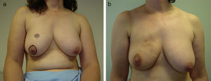 Deformity due to fat necrosis. This patient has a multinodular deformity in the right upper pole after removing a carcinoma through an areolar access, due to local fat necrosis following breast irradiation.