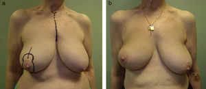 Breast shape asymmetry after a unilateral vertical pattern. This patient rejected a procedure for symmetry on her left breast after the indication of a vertical mammoplasty. Even though the amount of tissue removed from the right breast was scarce, performing a unilateral vertical pattern resulted in breast shape asymmetry although both breasts have a similar volume.