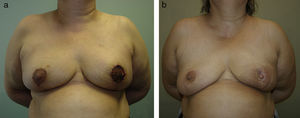Discoloured areola after superficial ischaemia in a bilateral vertical mammoplasty.
