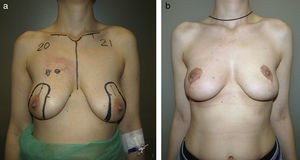 Excessive exposure of the lower pole after a vertical pattern. An excessive elevation of the nipple–areola complex over the inframammary fold has originated this excessive exposure of the lower pole.