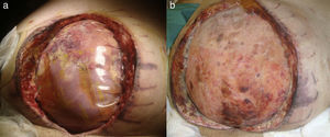 (A) Open abdominal decompression with a Bogota bag after abdominal compartment syndrome and (B) omentoplasty and substitutive supra-aponeurotic polypropylene mesh.