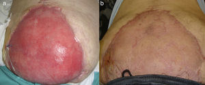 (A) Mesh integration and wound granulation after 6 weeks and (B) partial skin graft and epithelialization.