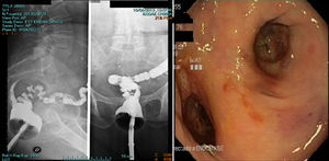 Barium enema and colonoscopy before treatment of the presacral sinus.