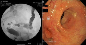 Barium enema and colonoscopy after treatment of the presacral sinus.
