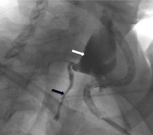 Lymphography of the thoracic duct (black arrow) after introducing contrast into the surgical drain and filling the cervical lymphocele (white arrow).