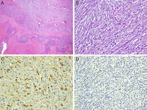 Histology: hematoxylin–eosin under low (A) and high magnification (B), showing a fibroinflammatory storiform proliferation with abundant plasma cells, many of which were positive for IgG (C) and very few for IgG4 (D).