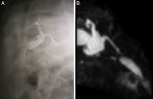 Dilatation of the common hepatic ducts and proximal common bile duct, with permeability of the implant (the gallbladder is also observed); (A) intraoperative cholangiography; (B) magnetic resonance cholangiopancreatography.