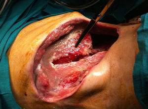 Necrotizing fasciitis and myositis of the right lumbotomy after temporary removal of the NPWT (without instillation of antibiotics). The scissors indicate the exposed liver with abundant necrotic tissue.