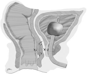 Transanal approach. Closure of the urethral orifice and total wall advancement flap.
