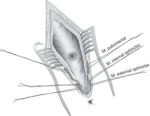 York-Mason: parasacrococcygeal, transsphincteric opening scheme.