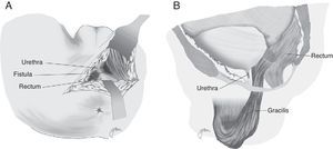(A) Perineal approach. (B) Closure of rectal and urethral orifices and interposition of the gracilis muscle.