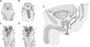 Perineal approach and interposition of dartos muscle. (A) Skin incision line. (B) Preparation of dartos flap. (C) Urethral and rectal sutures, in opposite directions. (D) Implantation of dartos flap. (E) Final scheme of dartos flap implantation.