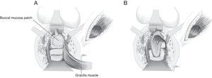 (A) Implantation of buccal mucosal patch over the urethra, and rectal suture in two planes. (B) Interposition of gracilis muscle.