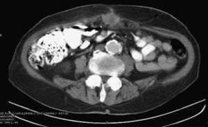 Abdominal CT with IV and oral contrast: round lesion with a hypodense (necrotic) center in the midline of the abdominal wall at the umbilical area, approximately 3.6cm.