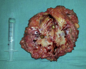 Intraoperative image: mass with granulomatous appearance containing several round lesions that give the impression of gallstones.