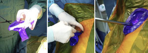 Protection of the port with the plastic covering from a light wand: (A) Section; (B) Placement with Kocher forceps; (C) Insertion of the thoracoscope and surgical instruments.