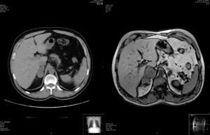 On the left, CT scan showing a nonspecific nodular lesion in the right suprarenal gland that measured 4×2.5×2cm. On the right, magnetic resonance done 4 weeks later shows a right suprarenal mass that is heterogeneous and measures 6.8×4.4×3.9cm.
