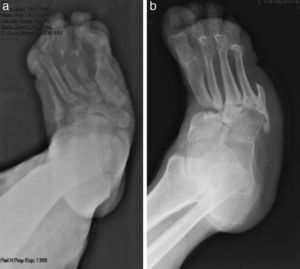 (a) X-ray showing Sanders’ Charcot Foot type I affecting the metatarsal–phalangeal joints. (b) X-ray showing Sanders’ Charcot Foot type II affecting the Lisfranc joint. Prior amputation of the 5th toe.