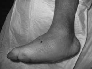 Charcot Foot with complete loss of the arch of the foot (rocking-chair foot).