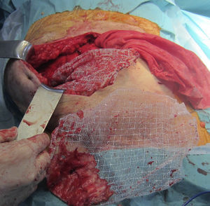 Detailed image of the abdominal wall showing how the right subcutaneous flap was created, the site of the premuscular rejection, and wrinkled mesh with no integration.