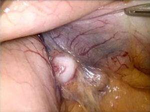 Image of pathologic lymph nodes during exploratory laparoscopy.