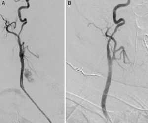Arteriography: (A) active hemorrhage of the right common carotid artery; (B) right common carotid artery with no contrast extravasation after stent placement