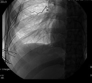 Intercostal artery embolization: embolization of the distal part of the intercostal arteries of the intercostal space through which the drain tube enters the thoracic cavity.