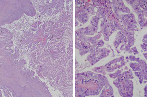 Cystic neoplasm forming papillary structures, covered by an atypical mucin-producing glandular epithelium. Hematoxylin eosin: left photo 1.25× and right photo 40×.