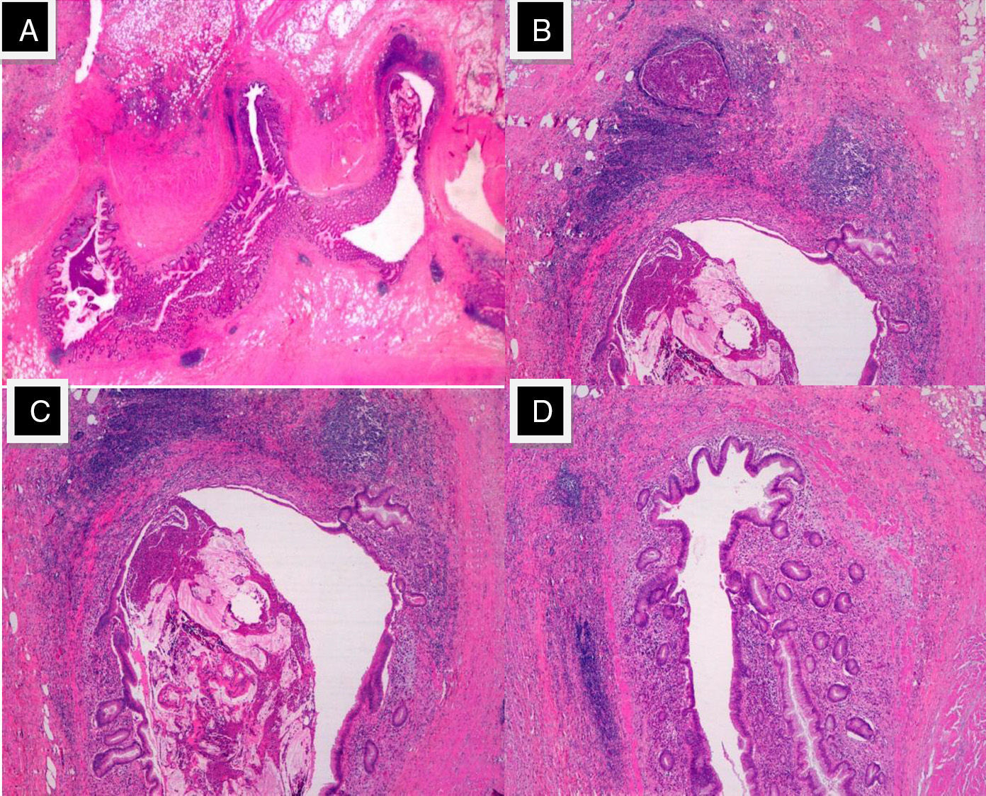 Appendiceal Diverticulitis: A Possible Diagnosis in Acute Abdomen ...