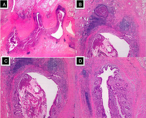 (A) Multiple “false” diverticula on the mesenteric edge of the distal end of the appendix (HE, 4×); (B and C) diverticular wall made up of mucosa and muscularis mucosae, pushing the muscularis propria and forming eosinophil abscesses. (HE, 20×); (D) diverticula occupied by mucus (mucocele) and a large eosinophil content (HE, 40×).