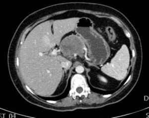 Pancreatic CT scan (axial view) showing direct compression on the bifurcation of the celiac trunk with the splenic and common hepatic arteries.