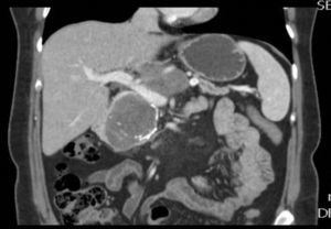 Abdominal CT (coronal view) showing displacement and compression of the splenoportal axis and splenic vein.