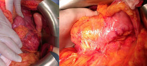 Surgical image of the tumor affecting the head, uncinate process and body of the pancreas.