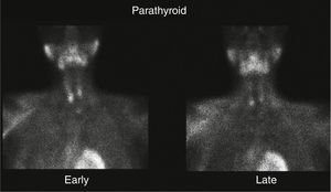 Parathyroid scintigraphy showing 2 deposits of activity in the lower poles, compatible with parathyroid adenomas.