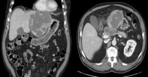 CT scan showing a 12cm tumor mass in the left liver lobe, together with a 6cm lymph-node conglomerate in the celiac trunk and infiltration of the common hepatic artery.