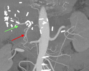 CT angiogram 15 days after surgery showing hepatic vascularization through the gastroduodenal artery (red) and proper hepatic artery (green).