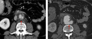 (A) Transversal abdominal CT scan at admission showing a saccular aneurysm measuring 3.5cm and increased retroperitoneal and periaortic density; and (B) transversal scan 5 days later demonstrating rapid growth of the aneurysm (maximum diameter: 5.2) versus contained rupture.
