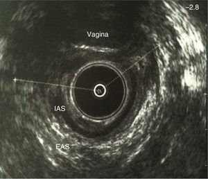 Endoanal ultrasound showing injury to both sphincters after obstetrical trauma; in the anterior region, the examiner's glove is observed in the vagina. EAS: external anal sphincter; IAS: internal anal sphincter.