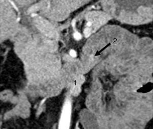 CT scan showing a bilobular, hypervascular mass in arterial phase in the 3rd part of the duodenum (lower edger) that showed caudal and exophytic growth (27mm×11mm) and corresponded with metastatic lymph nodes (1). Approximately 2cm distal to this lesion, there is a second hypervascular image measuring 7mm, which was a gastrinoma of the 3rd portion of the duodenum (2).