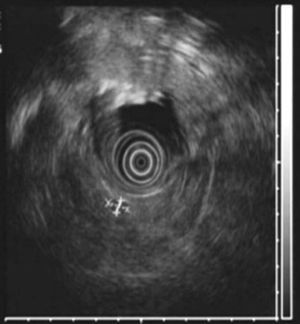 Endoscopic ultrasound showing a nodule in the wall of the 2nd portion of the duodenum (11mm).