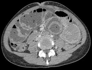 Abdominal-pelvic CT scan.