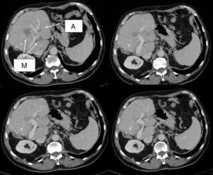 Initial CT scan showing the metastasis in segment IV in contact with the left portal vein and encompassing the portal branch of the segment, one of the metastases in segment II (M) and an angioma (A).