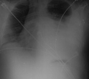 Chest radiograph after 48h: rapid progression with opacification of 2/3 of the left hemithorax.